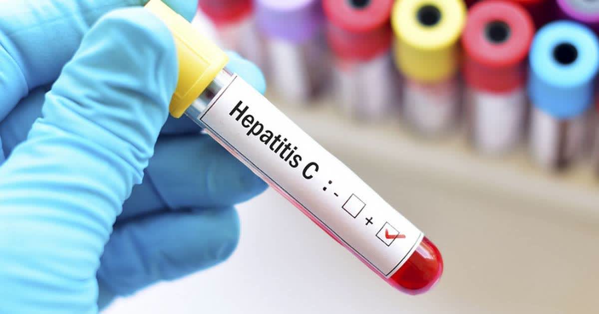 Argentina registra hasta 800 casos anuales de hepatitis C